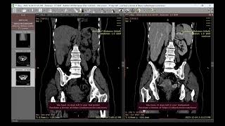 Liver abscess pyogenic [upl. by Ileak]