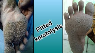 Pitted Keratolysis [upl. by Lledal]