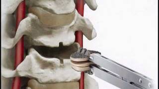 SecureC Cervical artificial disc Replacement Hussien ElMaghraby [upl. by Steffie]