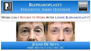 Lower Blepharoplasty Recovery Returning to Work after Lower Eyelid Surgery [upl. by Alard880]