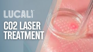 CO2 Laser Resurfacing Treatment [upl. by Donella971]