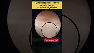 Hysteroscopic adhesiolysis for patients with Ashermans syndrome by Dr Rakshita Malik doctor mbbs [upl. by Lallage]