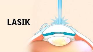 LASIK Surgery and its Risks [upl. by Ceil2]