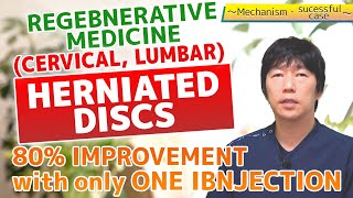 Regenerative Medicine for herniated disk Amazing recovery Doctors commentary [upl. by Netsruk]