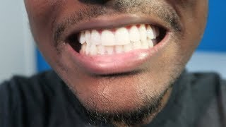 Crest 3D Whitestrips • 3 Months Later ReviewTips Whiten Your Teeth [upl. by Norahs]