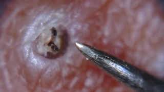 Itchy ingrown hair removed [upl. by Oreves]