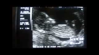 NUCHAL TRANSLUCENCY on ordinary ultrasound machine [upl. by Zellner199]