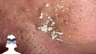 PIMPLE POPPING This Week 37 [upl. by Letisha]