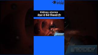 Kidney stones Treatment  RIRS  Laser kidney stone treatment shorts [upl. by Pitts]