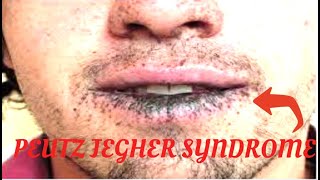 PEUTZ JEGHERS SYNDROME  What is Peutz Jeghers syndrome  Symptoms of peutz jeghers syndrome [upl. by Lesde]