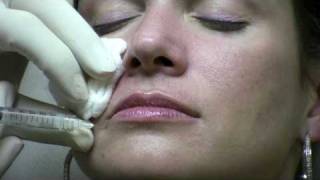 Juvederm Ultra Injection to NasoLabial Folds laugh lines by Reston Virginia Cosmetic Surgeon [upl. by Etam]