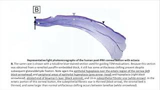 Corneal Ectasia Basics – A Deep Dive [upl. by Anan724]