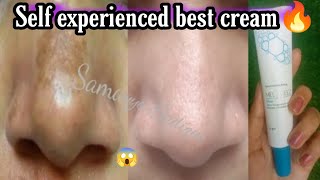 Self experienced best cream for melasma  melaneez cream review [upl. by Moritz]