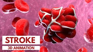 Understanding the Different Types of Stroke  3D Animation [upl. by Eldreda]