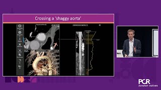 The many faces of complex TAVI  PCR London Valves 2024 [upl. by Hamlin550]