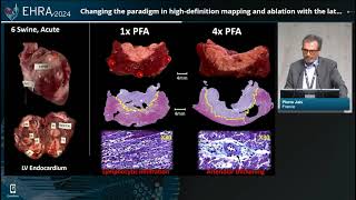 EHRA Congress 2024 Highdefinition mapping and ablation [upl. by Seldon]