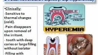 Pulp Diseases Oral Pathologywmv [upl. by Clougher]