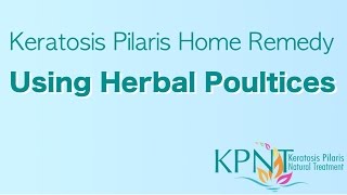 Keratosis Pilaris Home Remedy Using Herbal Poultices Video [upl. by Inan206]