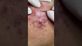 Inflamed Acne and Blackhead Removal CloseUp Secrets to Clear and Smooth Skin [upl. by Bigg374]