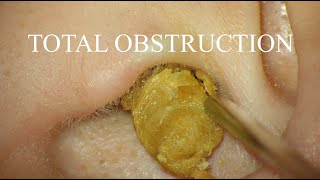 TOTAL OBSTRUCTION  EAR WAX REMOVAL  4KHD [upl. by Beverlee570]