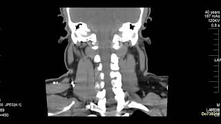 case 10  hoarseness of voice [upl. by Shiverick70]