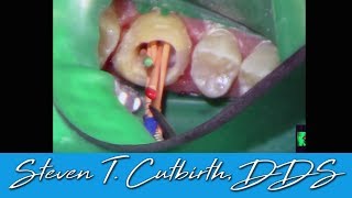 Endo of 5 Canal Molar  Dental Minute with Steven T Cutbirth DDS [upl. by Eilram]