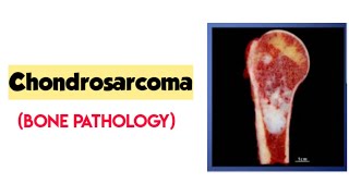 ChondrosarcomaBone pathologyRobbins pathologybone tumorforward focused [upl. by Washington]