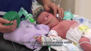 Paediatric Anaesthetics Chapter 4  Extubation neonate [upl. by Lerrad]