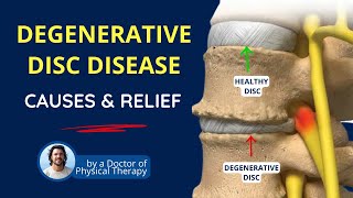 Degenerative Disc Disease Back Pain Causes Symptoms amp Relief [upl. by Notpmah]