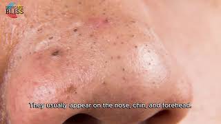 The WORST Skincare Mistake Thats Causing Blackheads can blackhead turn into pimple [upl. by Nhguav]