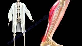 Achilles Tendon Stress amp Strain  Everything You Need To Know  Dr Nabil Ebraheim [upl. by Ecnal]