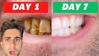 I Tried Crest Whitening Strips For 7 Days INSANE RESULTS Honest Review [upl. by Zinck]