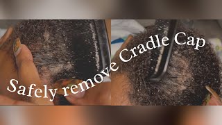 Mommy Mondays Ep 9 How to Safely Remove Cradle Cap [upl. by Pegasus]