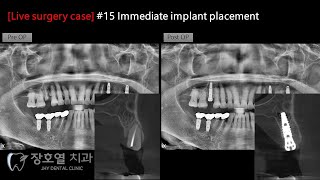 Live surgery Immediate implant placement with flapless approach [upl. by Aicsile]