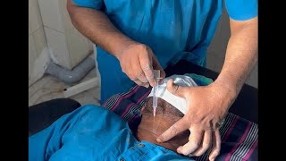 Needle cricothyroidotomy  DrSParthasarathy MD DNB PhD [upl. by Paco]