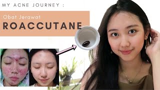 Acne Journey  OBAT ROACCUTANE [upl. by Kier]