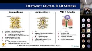 Neurogenic Claudication amp Lateral Recess Stenosis  Rick Lang MD on August 15 2022 [upl. by Drazze]