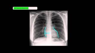 Chest XRay Reading Method  ABCDE UndergroundMed [upl. by Yrol361]