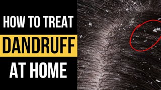 Doctor explains HOW TO TREAT DANDRUFF AT HOME and 5 different antidandruff shampoos to use [upl. by Blanch]