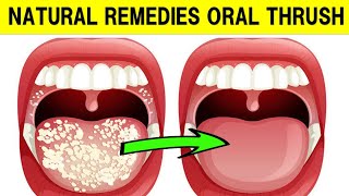 How To Treat Oral Thrush With Natural Remedies [upl. by Annert]