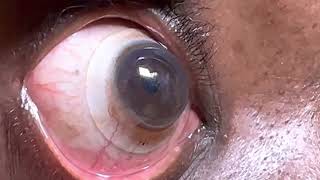 EyePrint Pro Scleral Lens Over An Eye With Advanced Keratoconus With Hydrops [upl. by Garrity542]