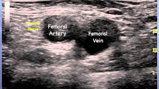 Femoral Nerve Sonoanatomy  QMH AED Ultrasound Casebook 2013 Video 12 [upl. by Annovahs]