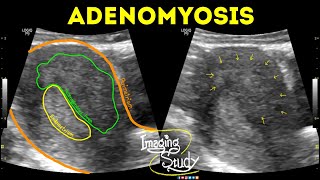 Adenomyosis  Ultrasound  Case 42 [upl. by Rednave]