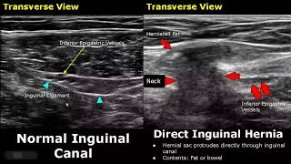 Hernia Ultrasound Normal Vs Abnormal Images  DirectIndirect InguinalEpigastricFemoral Hernia USG [upl. by Ybsorc687]