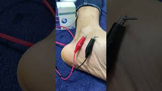 Dry needling  Tendinite de jambier posterieur douleur au pied [upl. by Cordier]