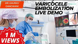 Live Varicocele Embolization Case 1 Nonsurgical treatment of Varicocele  Dr Gaurav Gangwani [upl. by Lammond]