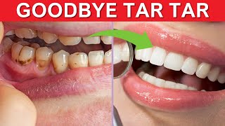 Eliminate Tartar Naturally Homemade Remedies to Remove Plaque amp Tartar Fast [upl. by Teyugn990]