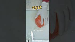 Ovarian cyst specimen [upl. by Ramal]