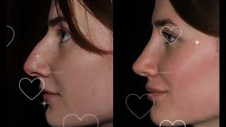 Virtual rhinoplasty [upl. by Elletnahs]