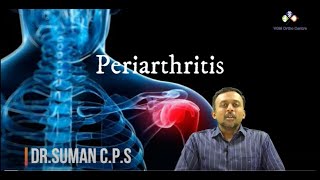 What is PERIARTHRITIS – SHOULDER PAIN What are its Remedies  by DrSuman CPS VGM Hospital [upl. by Simpson941]